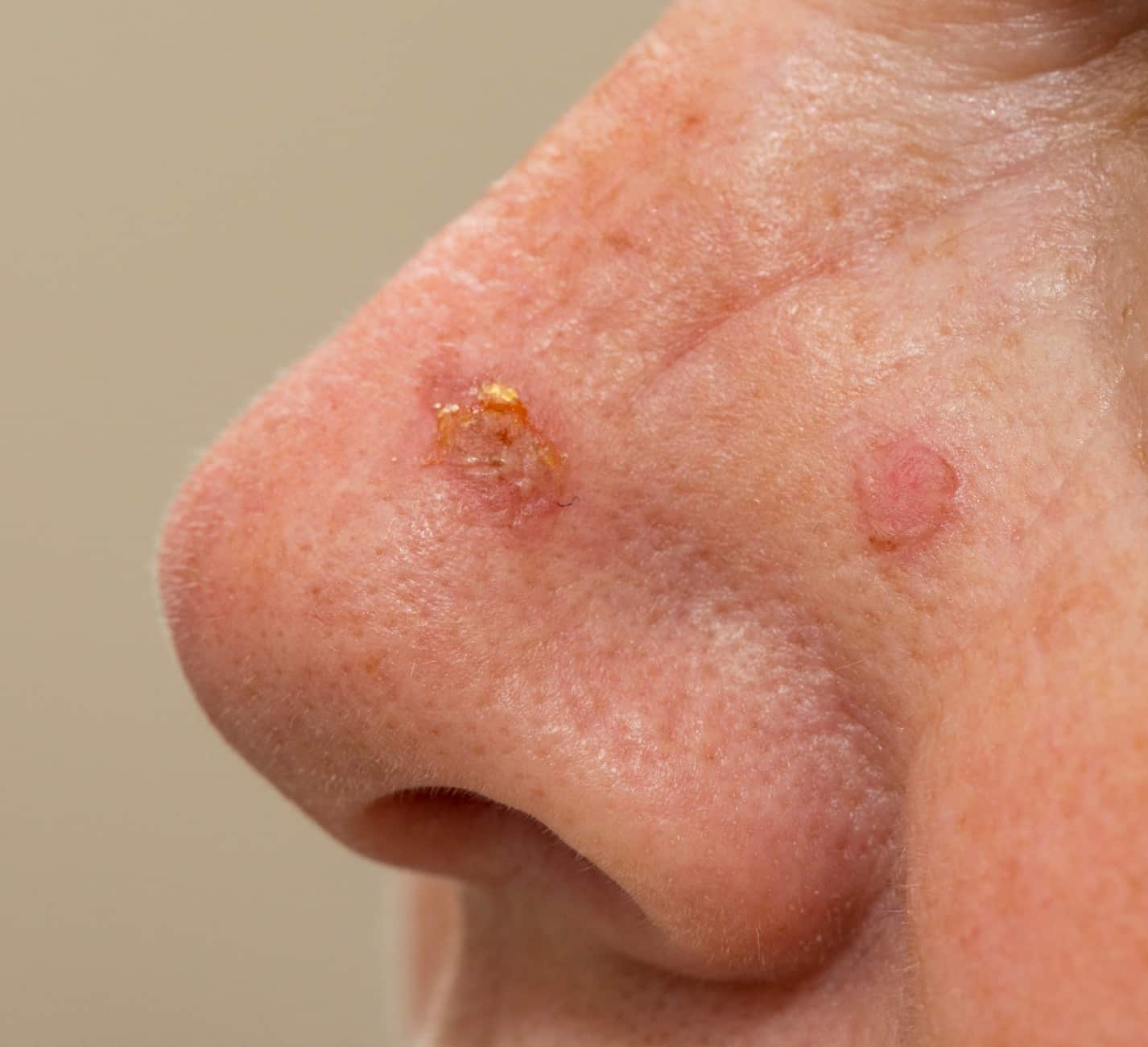 Carcinome basocellulaire visage | Photos carcinome basocellulaire | Dermatologie | Institut R.E.N | Gonesse