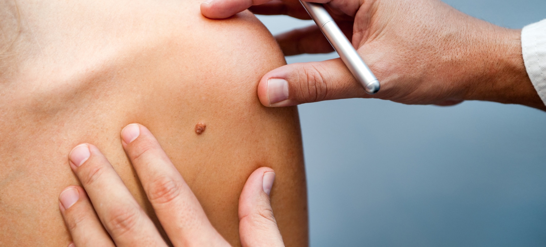 Grain de beauté : quand s'inquiéter ? | Cancer peau grain de beauté | Institut R.E.N | Gonesse